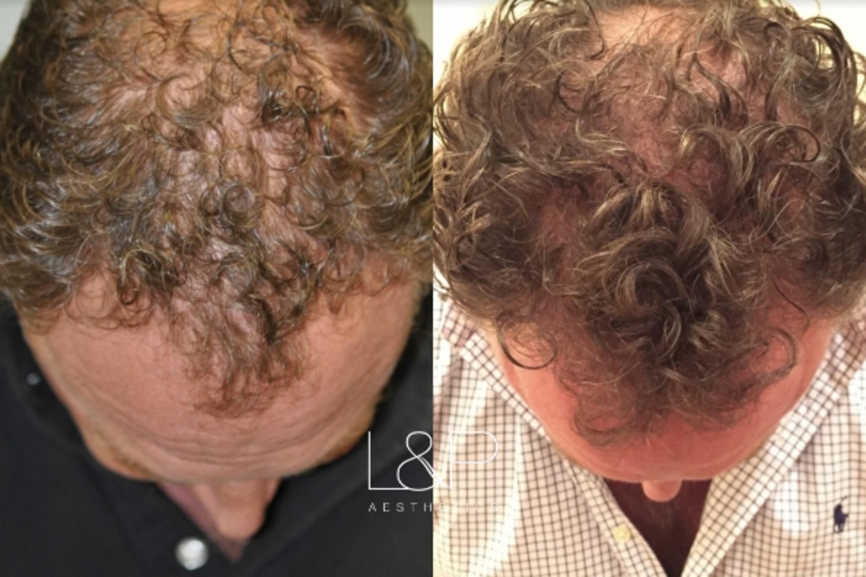 Hair Restoration before and after treatment