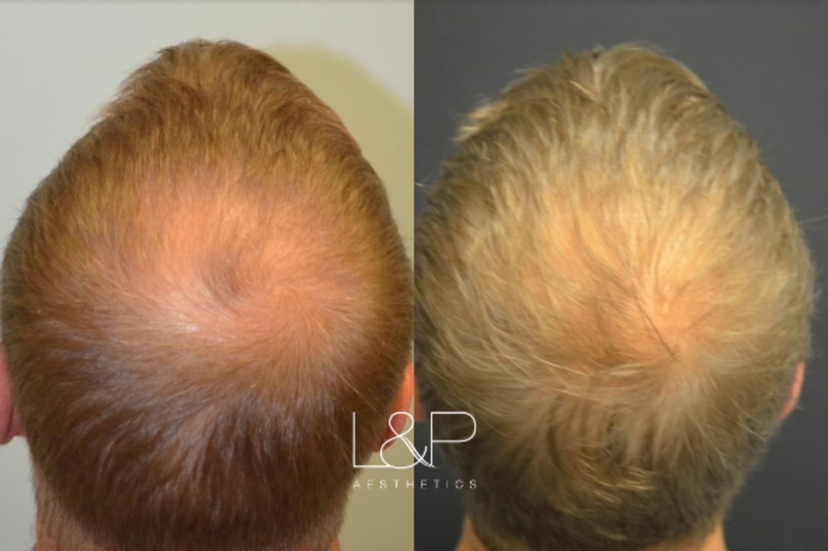 Hair Restoration before and after treatment