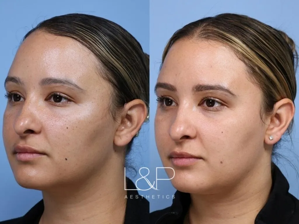 Young BBL before and after treatment