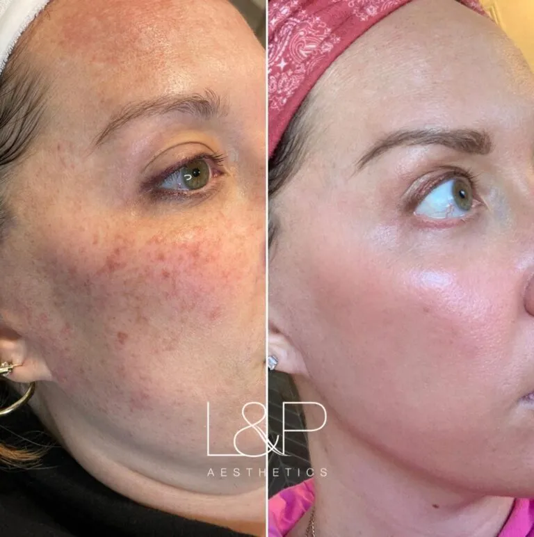 Young BBL before and after treatment