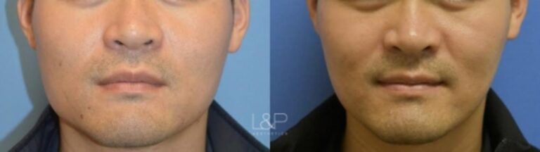 Jaw Slimming before and after treatment