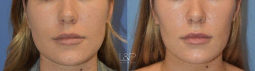 Jaw Slimming before and after treatment