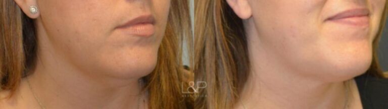 Kybella before and after treatment