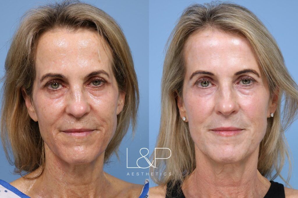 Laser Resurfacing before and after treatment