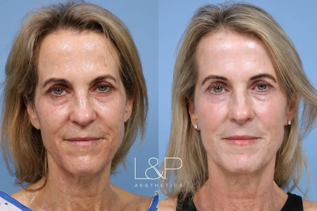 Laser Resurfacing TRL L P Aesthetics