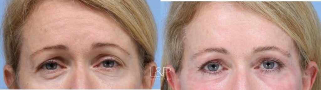 Laser Resurfacing before and after treatment