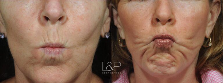 Lip Augmentation before and after treatment