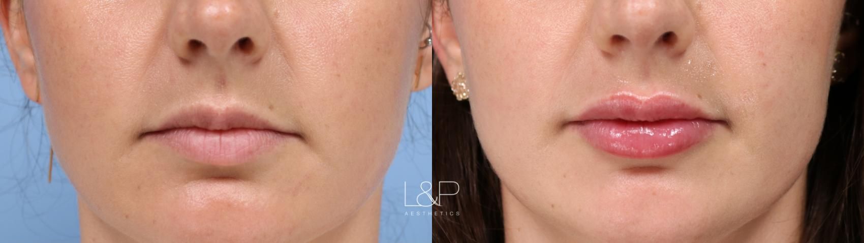 Lip Augmentation before and after treatment