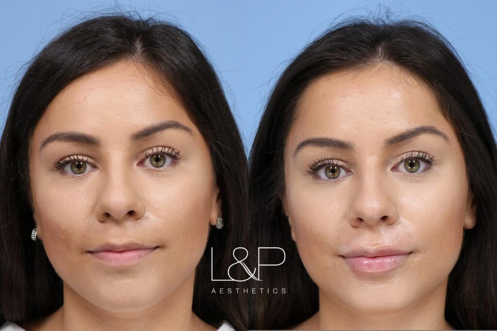 Lip Augmentation before and after treatment