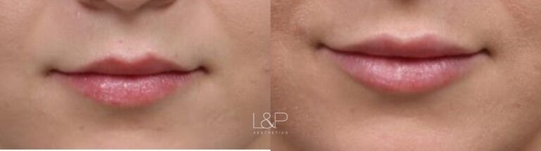 Lip Augmentation before and after treatment