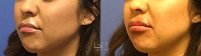 Lip Augmentation before and after treatment