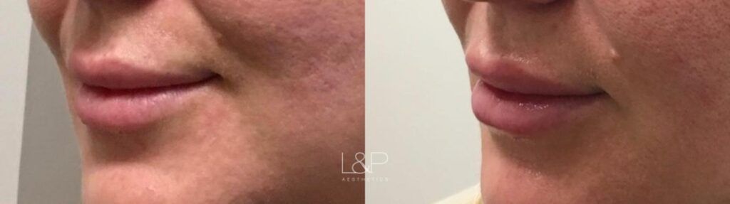 Lip Augmentation before and after treatment