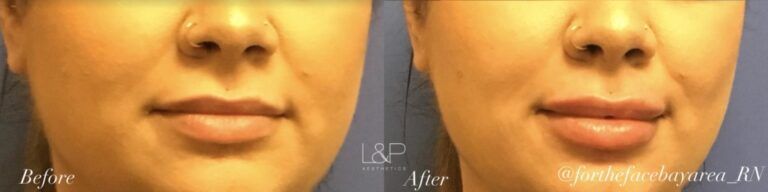 Lip Augmentation before and after treatment