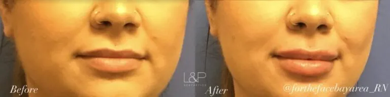 Lip Augmentation before and after treatment