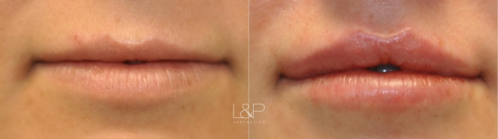 Lip Augmentation before and after treatment