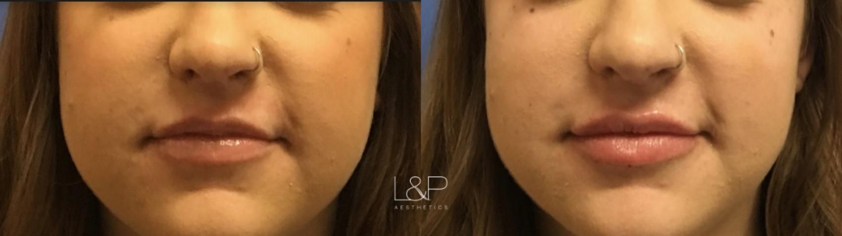 Lip Augmentation before and after treatment