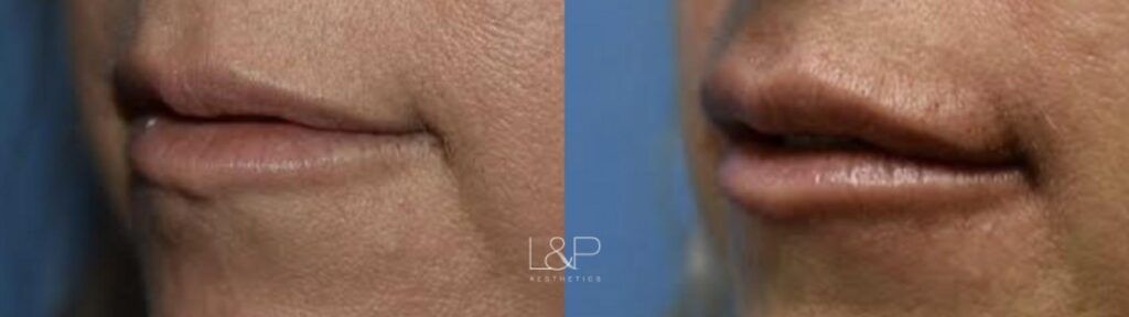 Lip Augmentation before and after treatment