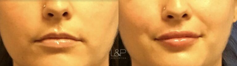 Lip Augmentation before and after treatment