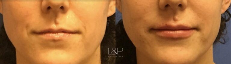 Lip Augmentation before and after treatment