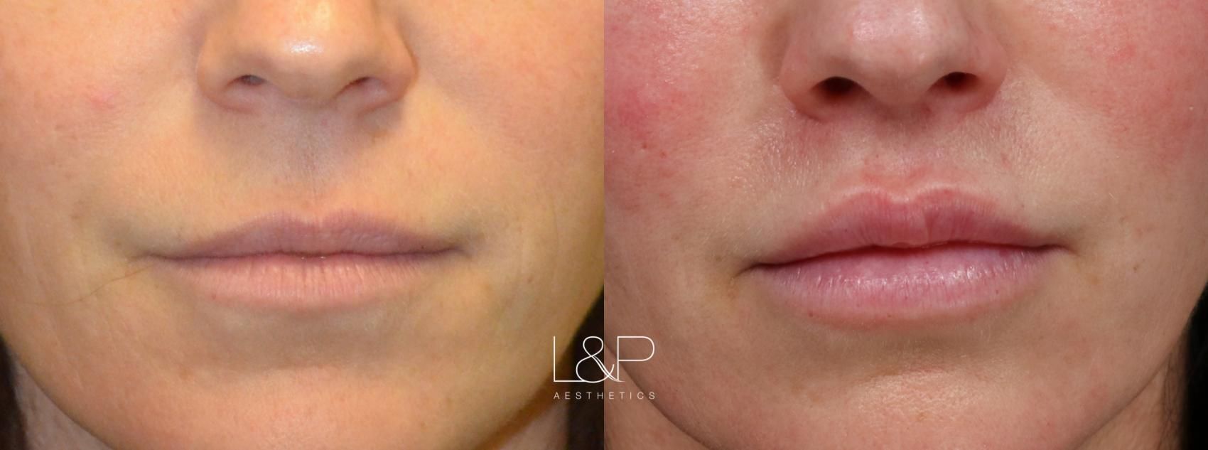 Lip Lift before and after treatment