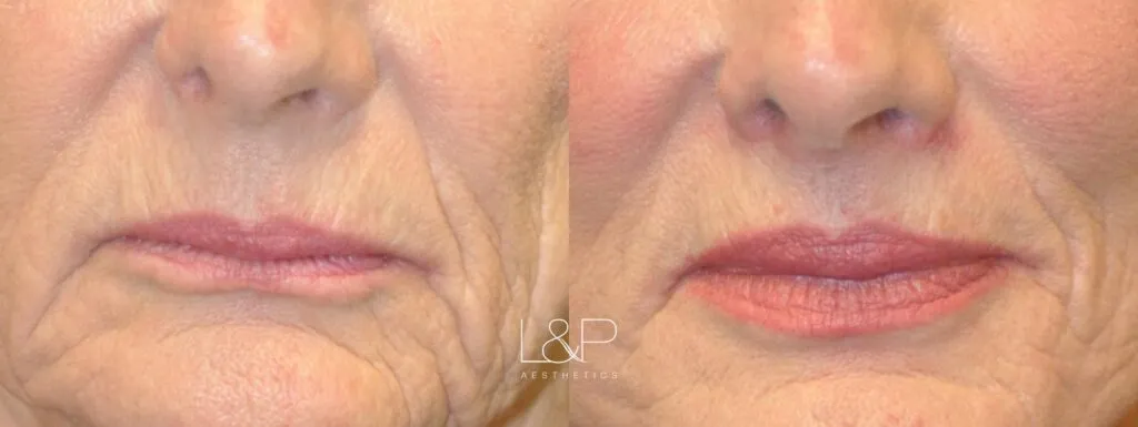 Lip Lift before and after treatment