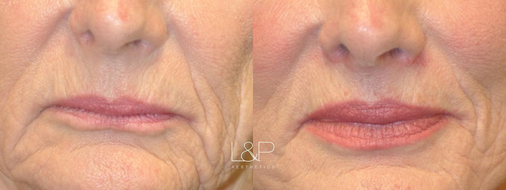 Lip Lift before and after treatment in California