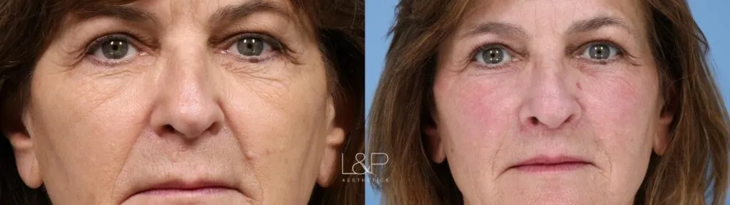 Laser Resurfacing TRL L P Aesthetics