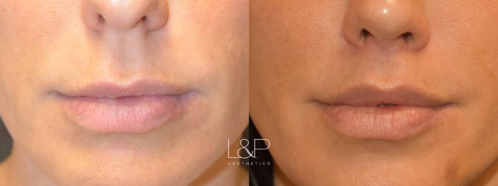 Lip Lift before and after treatment