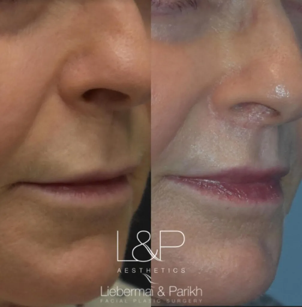Lip Lift before and after treatment