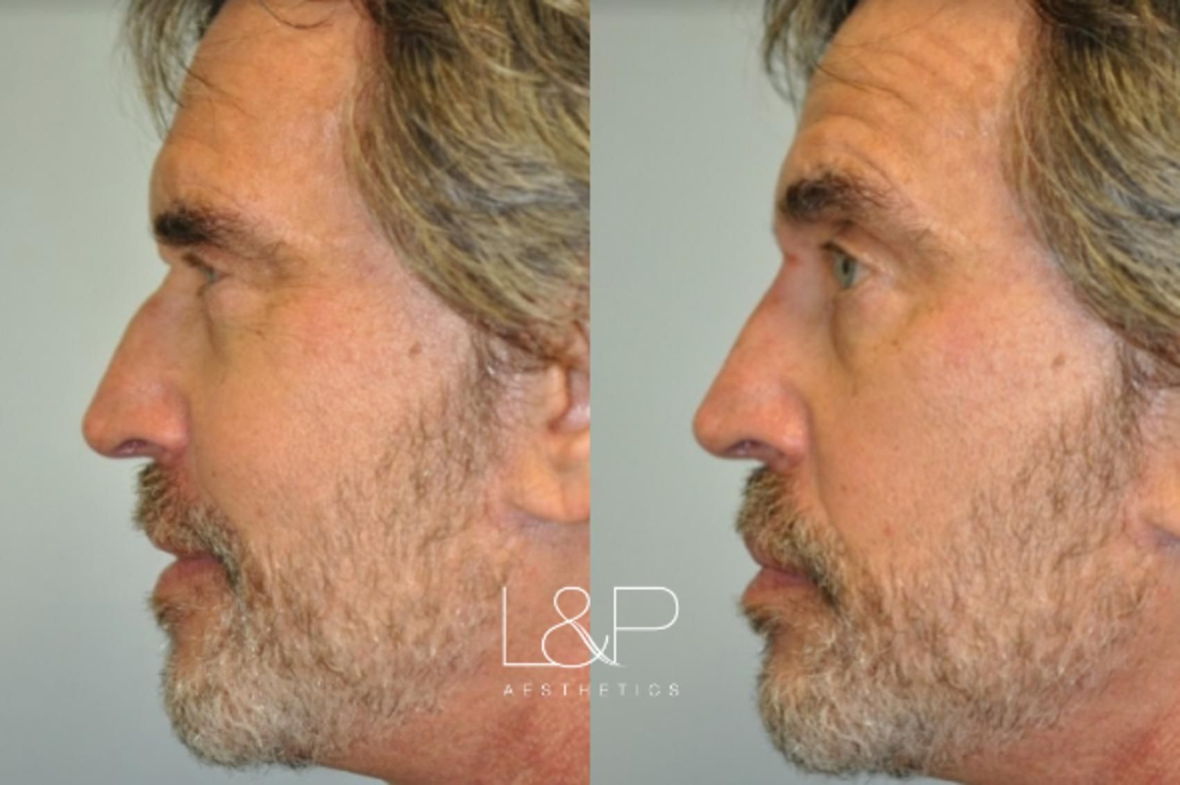 Liquid Rhinoplasty before and after treatment