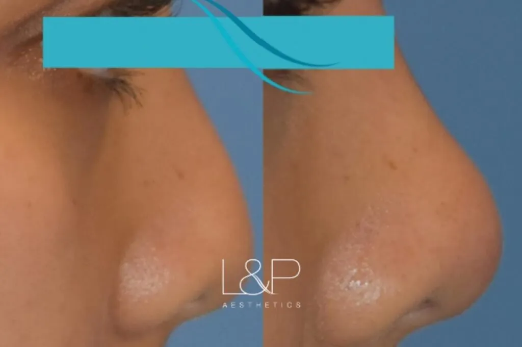 Liquid Rhinoplasty before and after treatment