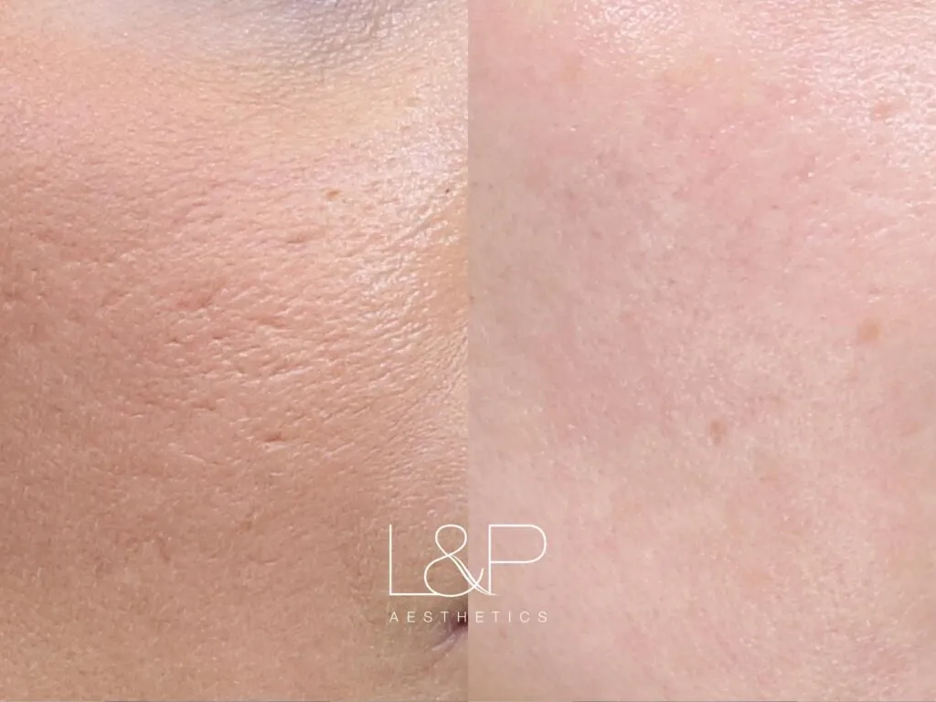 Microneedling Before And After Landp Aesthetics 6704