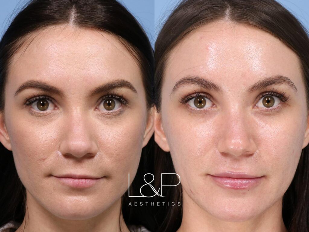 Microneedling before and after treatment