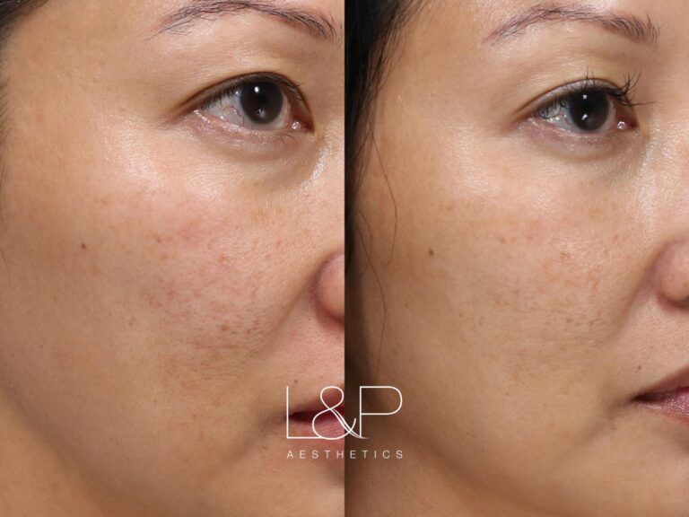Microneedling Before and after treatment