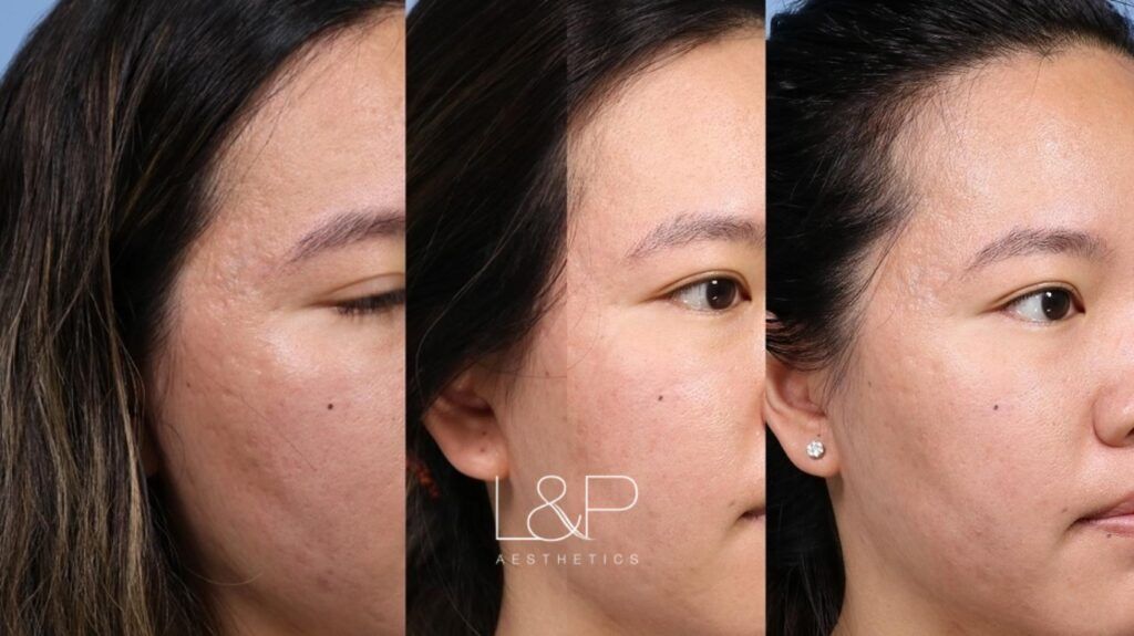 Microneedling Before and after treatment