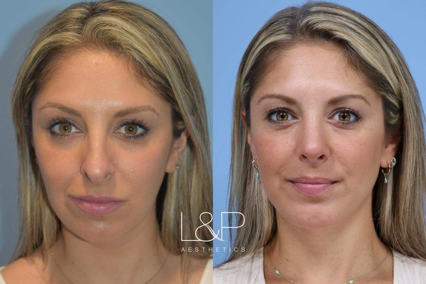 Midline Neck Lift before and after treatment