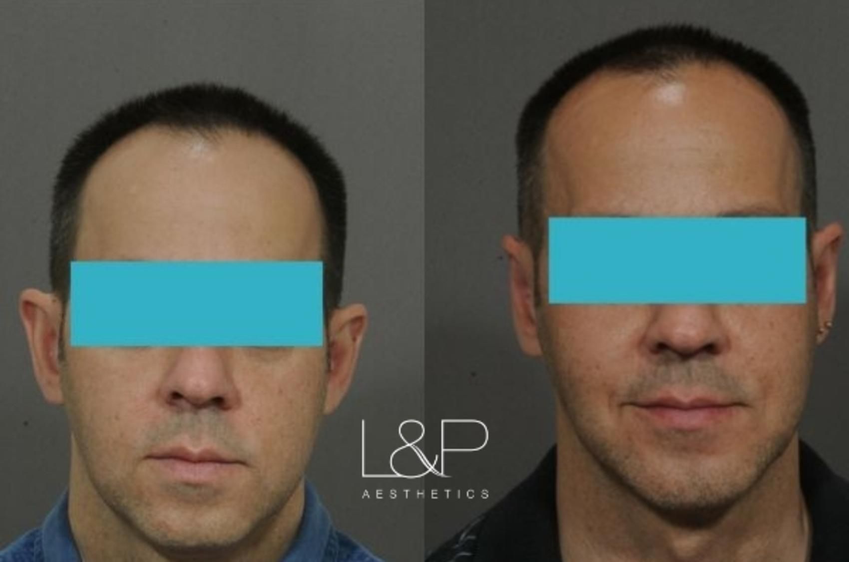 Otoplasty before and after treatment