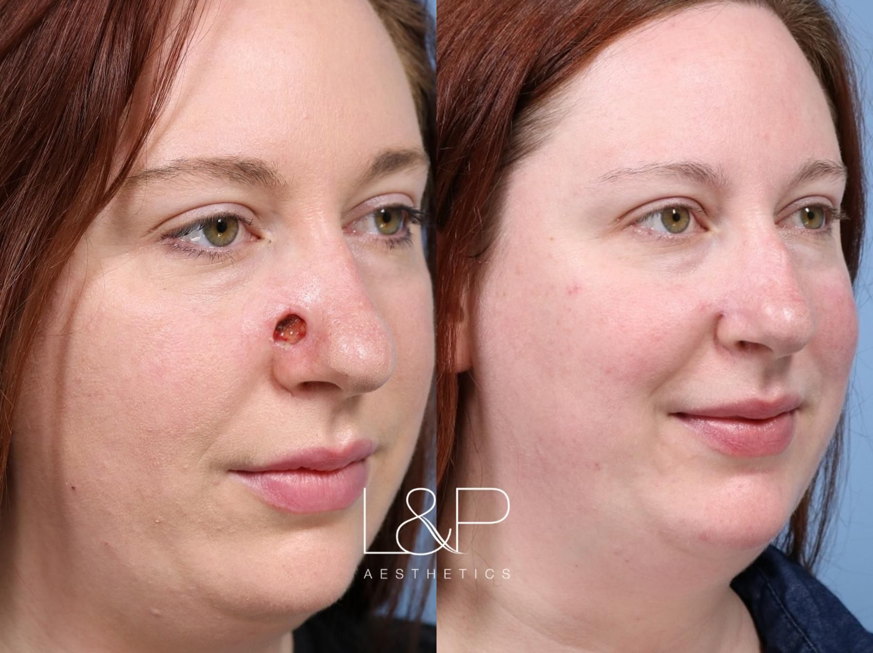 Reconstructive Surgery Before And After Case 217 Landp Aesthetics