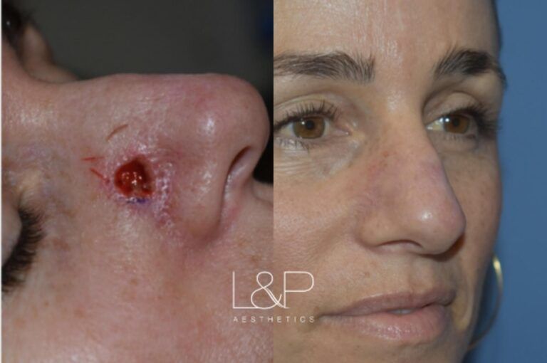 Reconstructive Surgery before and after treatment