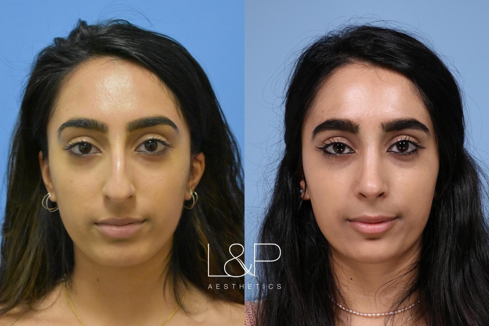 Rhinoplasty before and after treatment