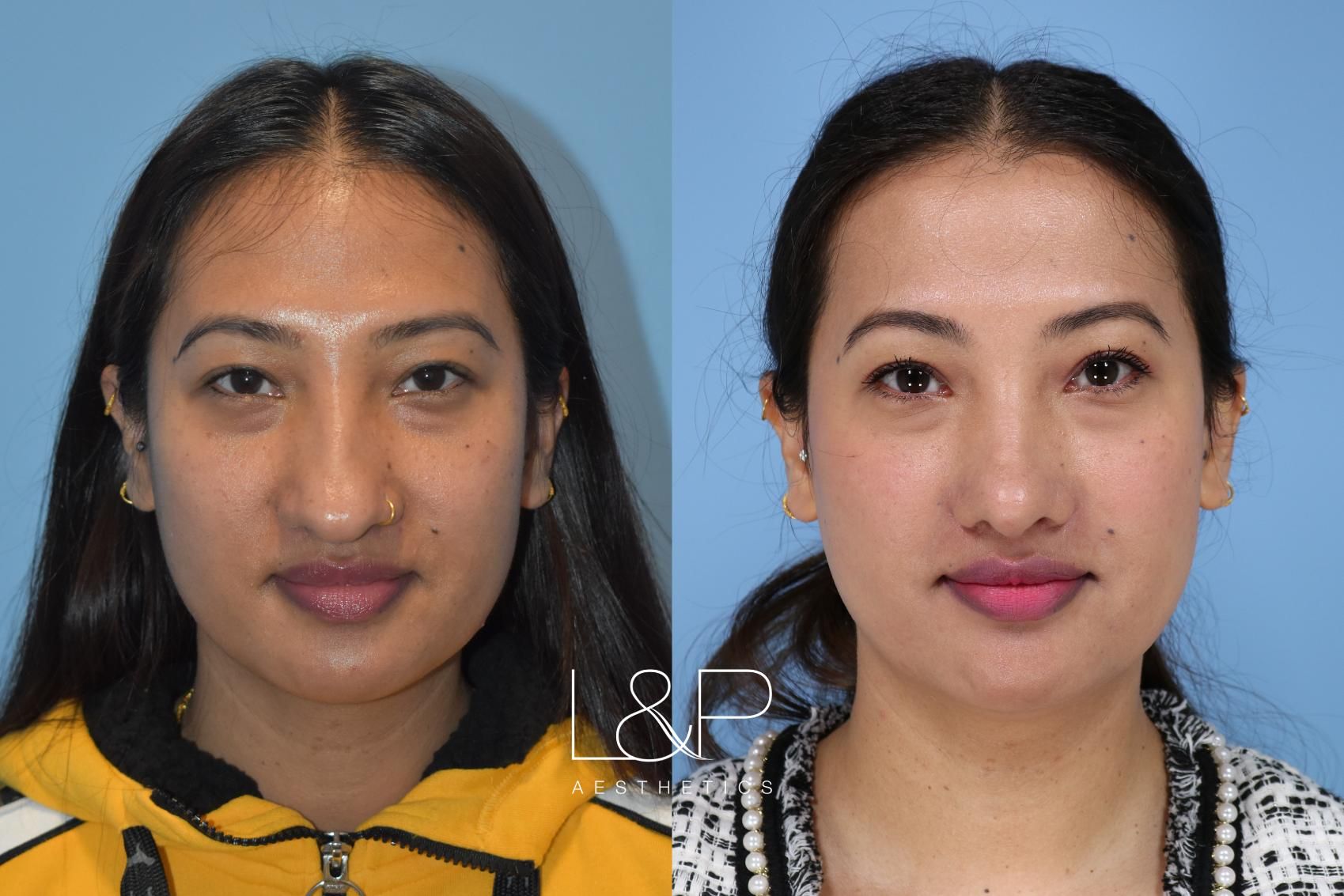 Rhinoplasty before and after treatment in Los Gatos, California