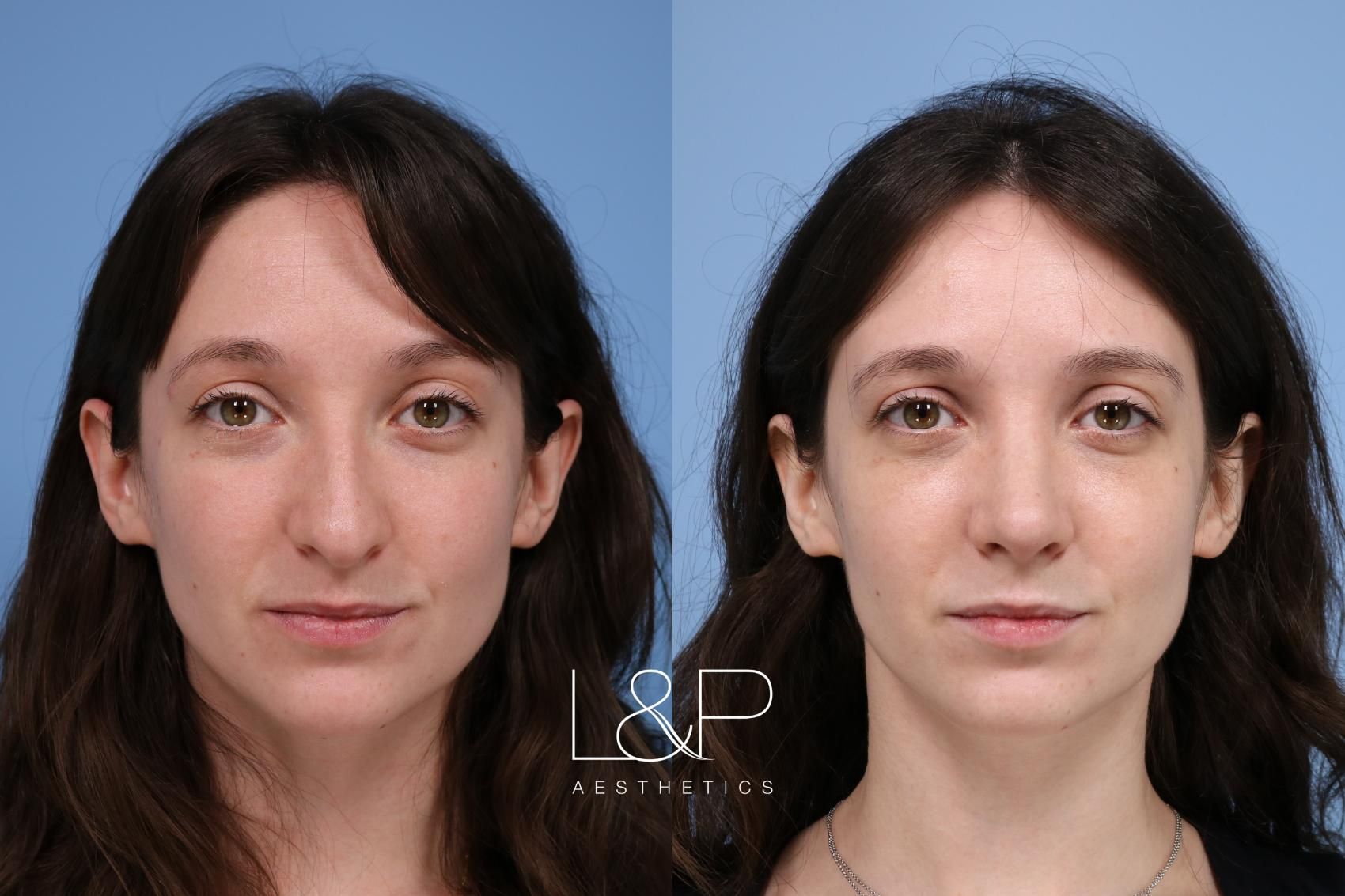 Rhinoplasty before and after treatment