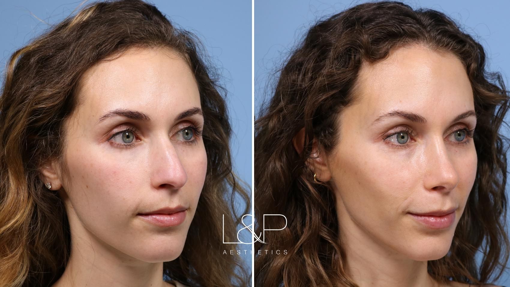 Rhinoplasty before and after treatment in Palo Alto, California