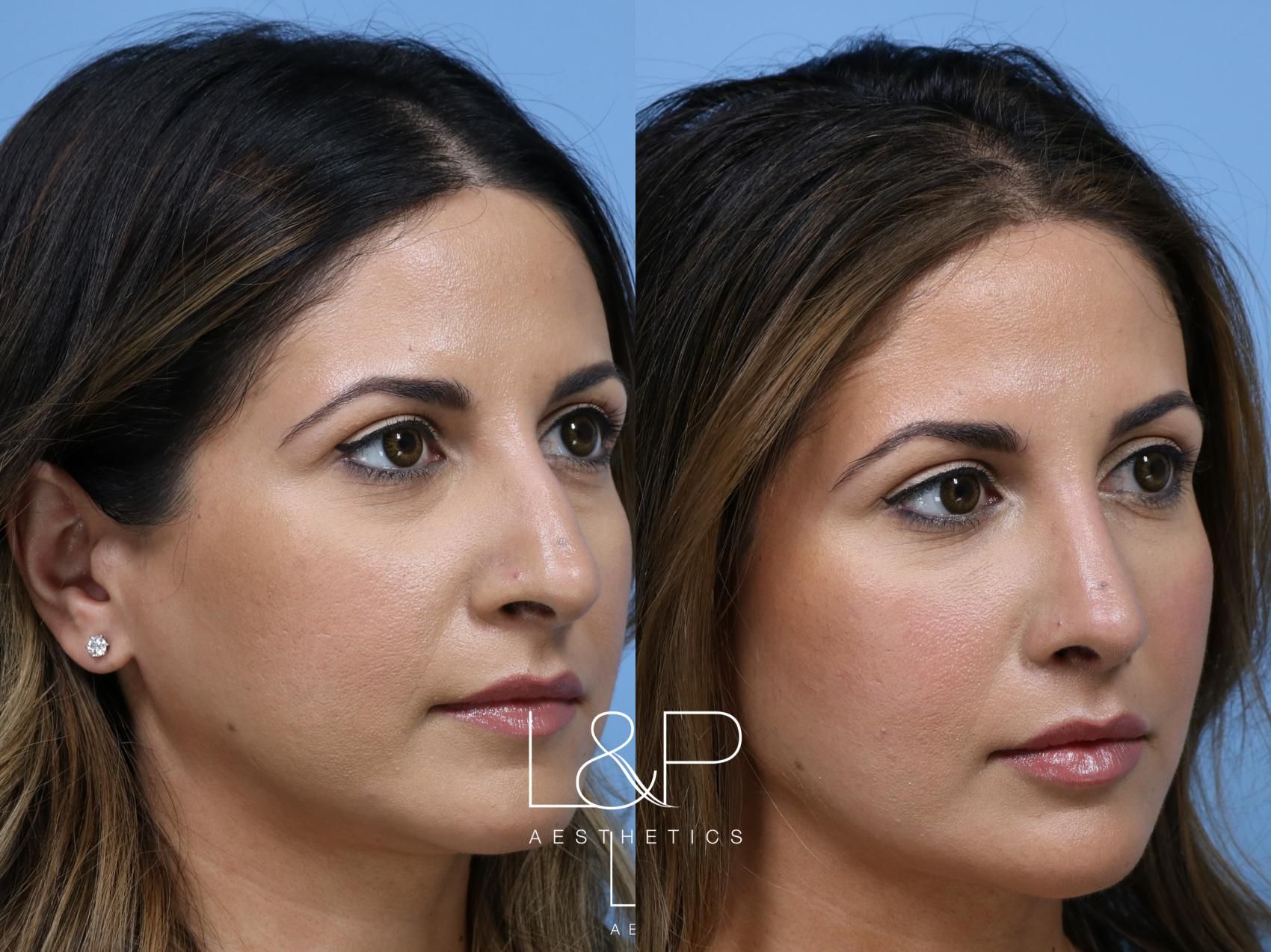 Rhinoplasty before and after treatment