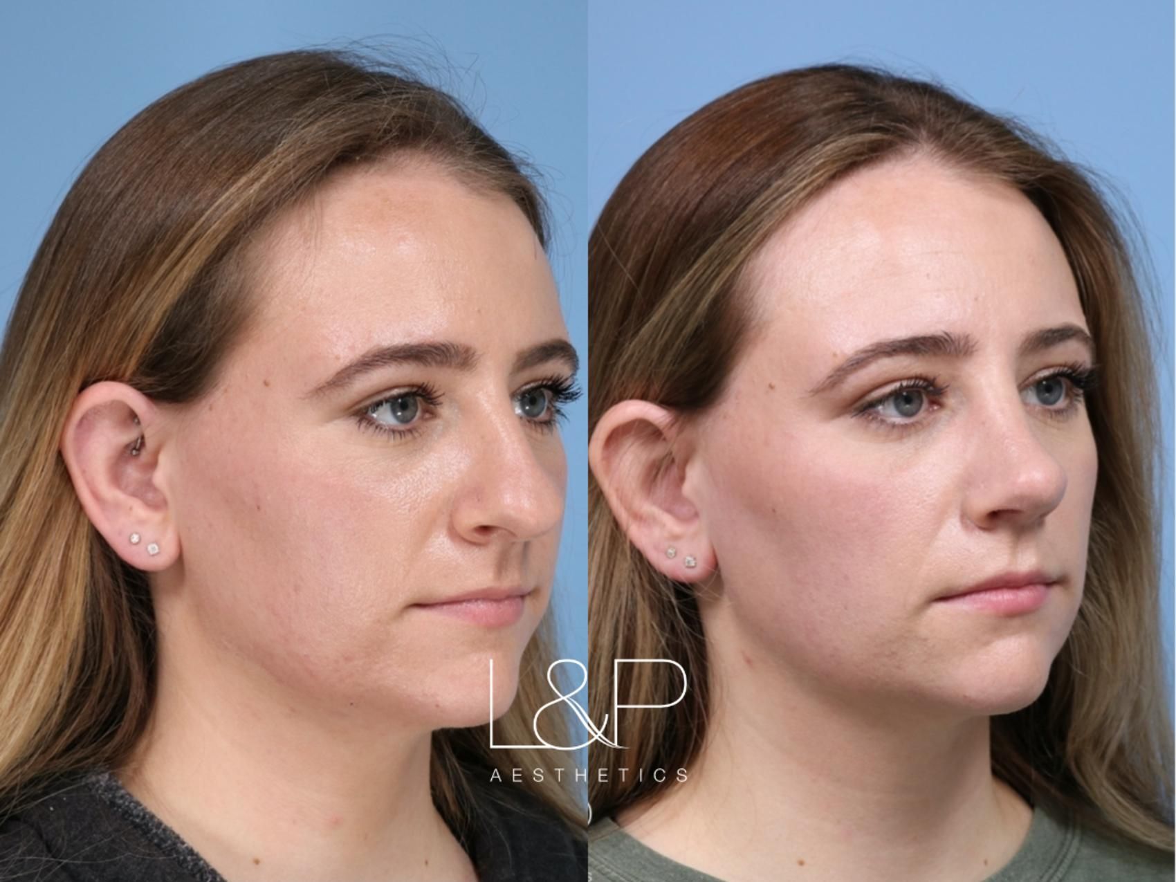 Rhinoplasty before and after treatment in the Bay Area