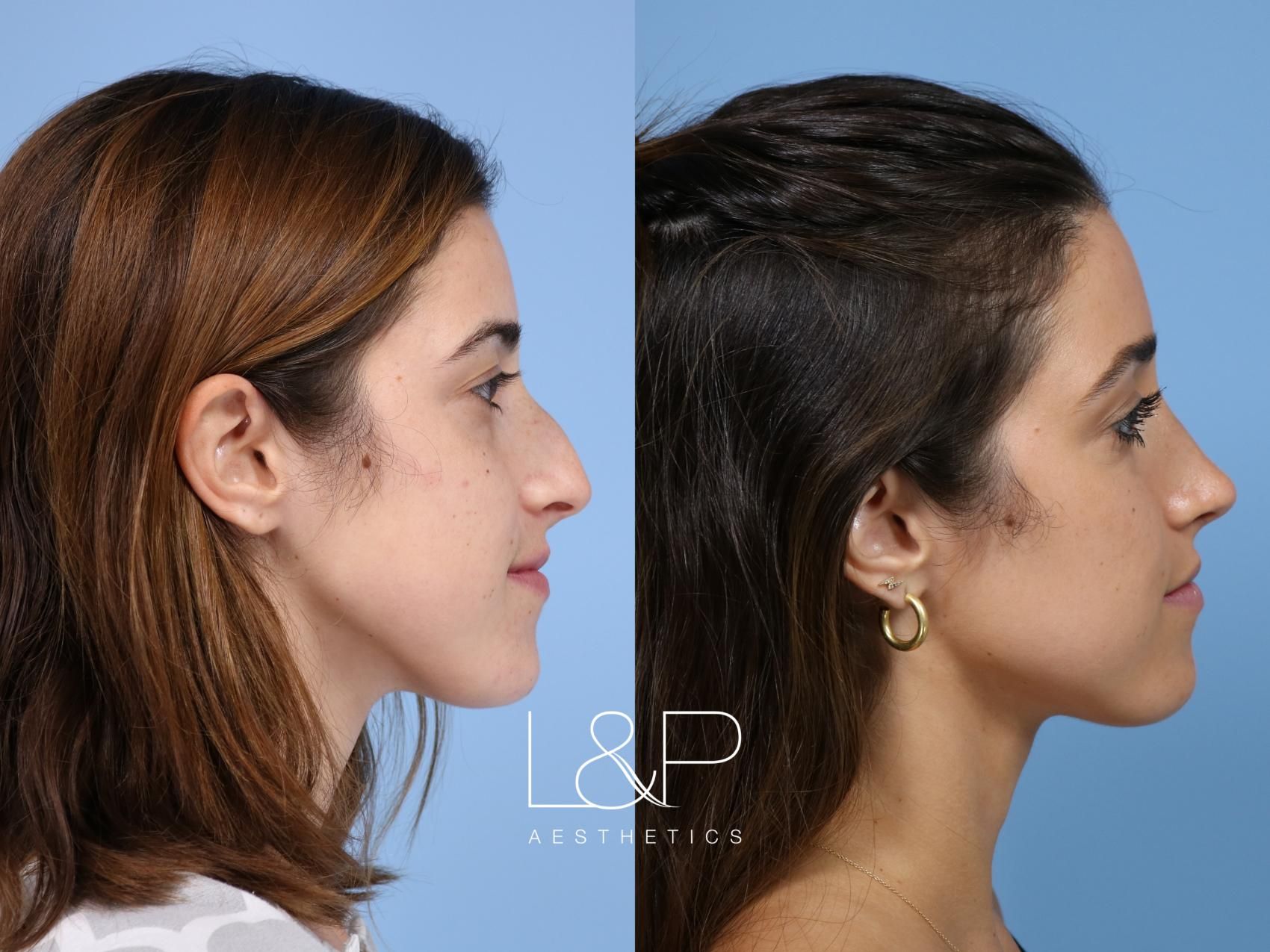 Rhinoplasty before and after treatment in the Bay Area