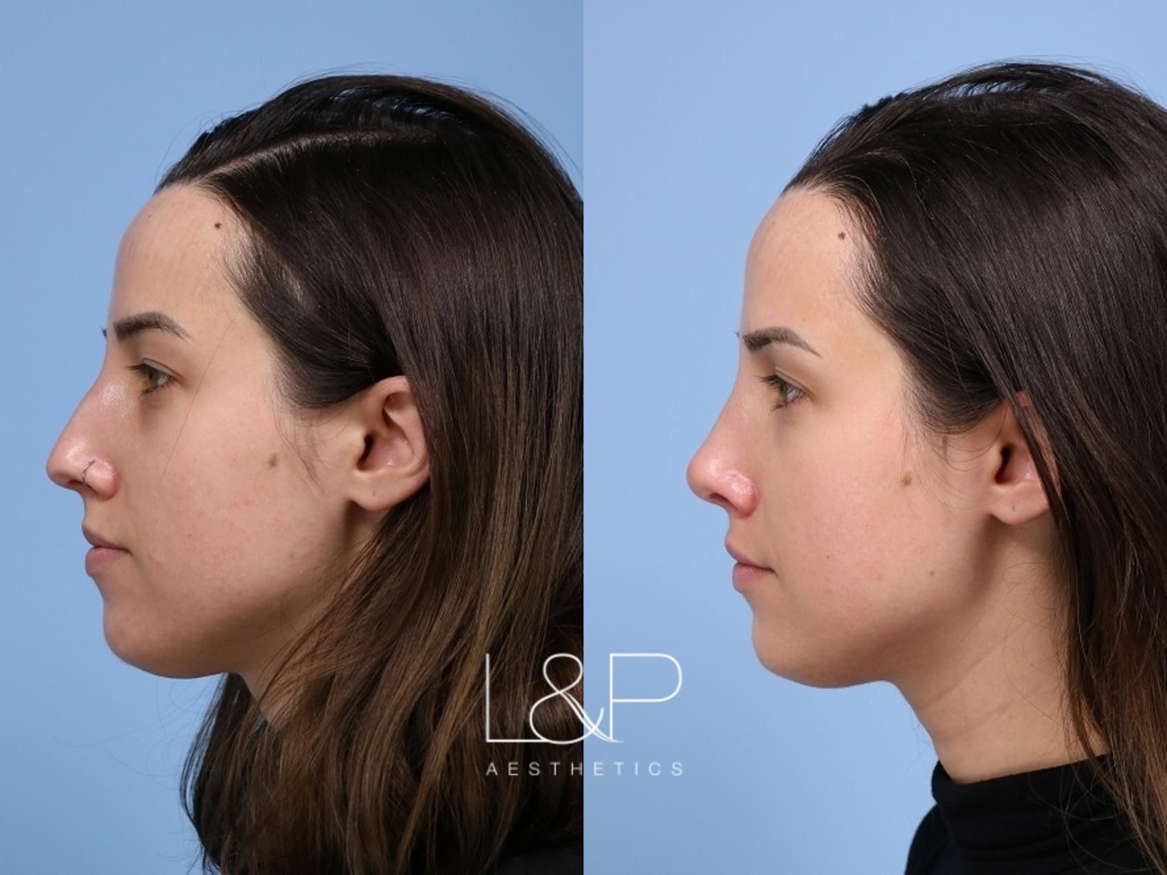 Rhinoplasty before and after treatment in Palo Alto, California