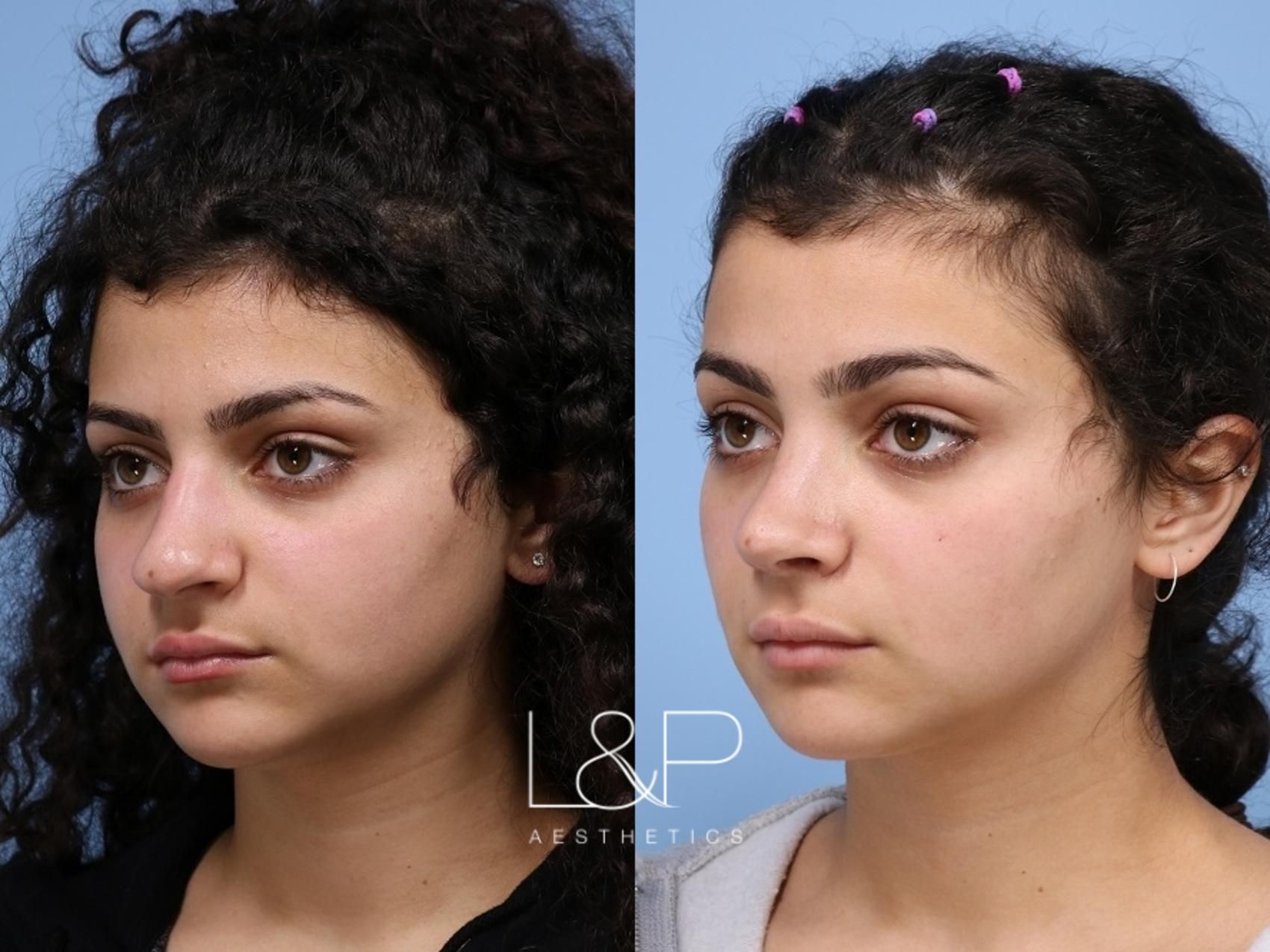 Rhinoplasty before and after treatment in Los Gatos, CA