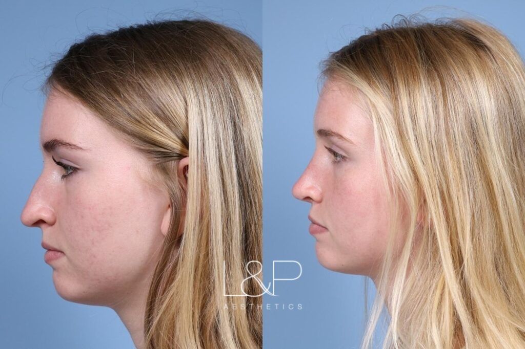 Rhinoplasty before and after treatment