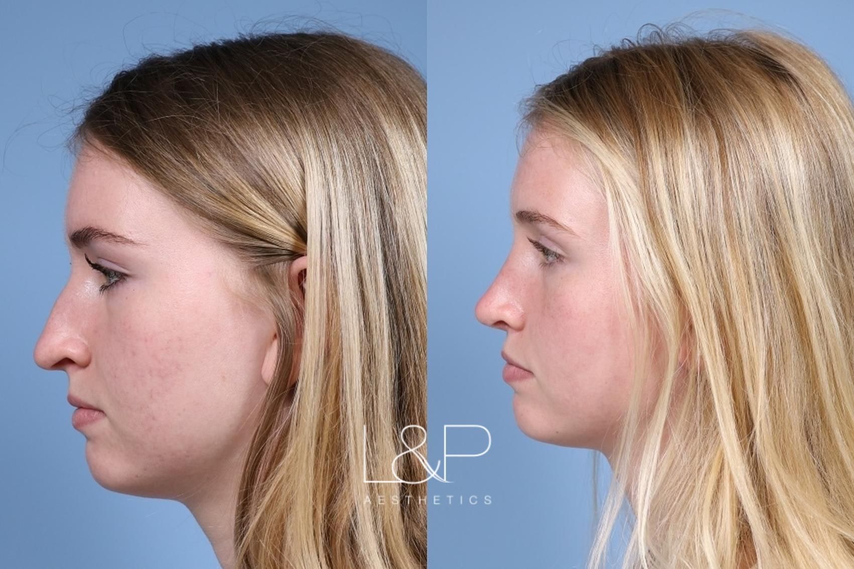 Rhinoplasty before and after treatment in Palo Alto, CA